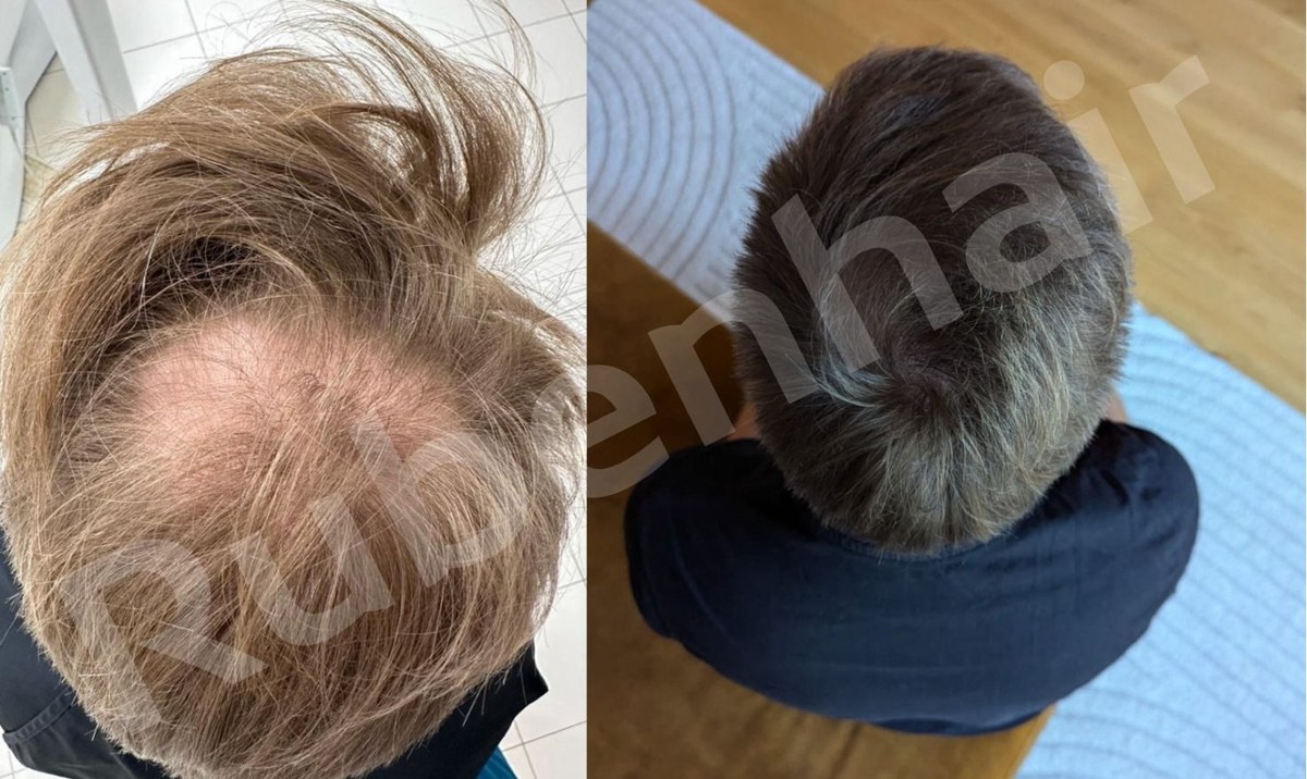 Matu transplantācija pirms un pēc — blīvuma atjaunošana, 1 gads